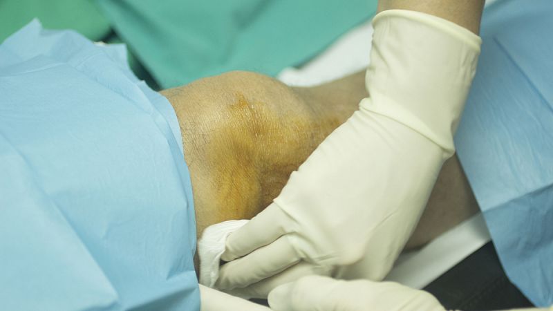 Cirujanos del hospital 12 de Octubre salvan la pierna de una anciana con una técnica pionera a nivel mundial
