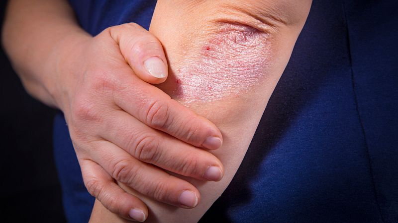 Identificada una molécula clave en el desarrollo de la psoriasis