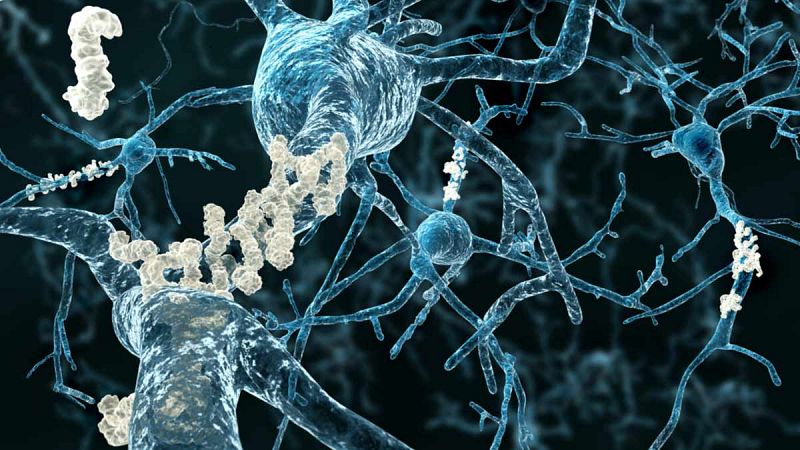 La Clínica Universidad de Navarra inicia un nuevo ensayo clínico para "limpiar" el cerebro de alzhéimer