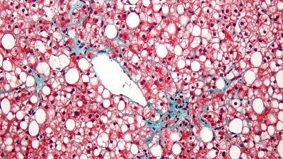 El laboratorio de JAL - Todos contra la hepatitis - 13/02/17 - Escuchar ahora