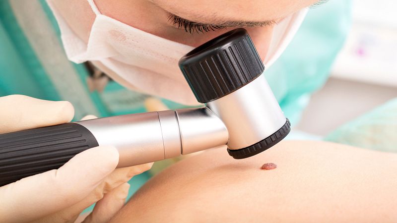 Desarrollan una nueva técnica de diagnóstico para la detección precoz del melanoma