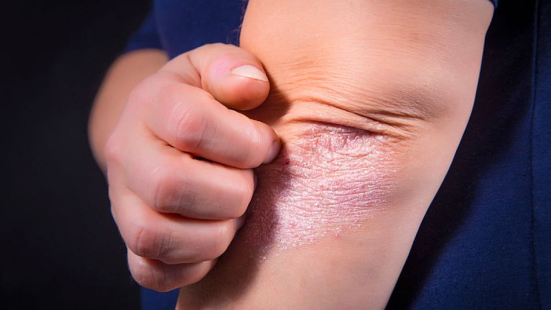 La psoriasis más grave es mucho más frecuente entre la población masculina