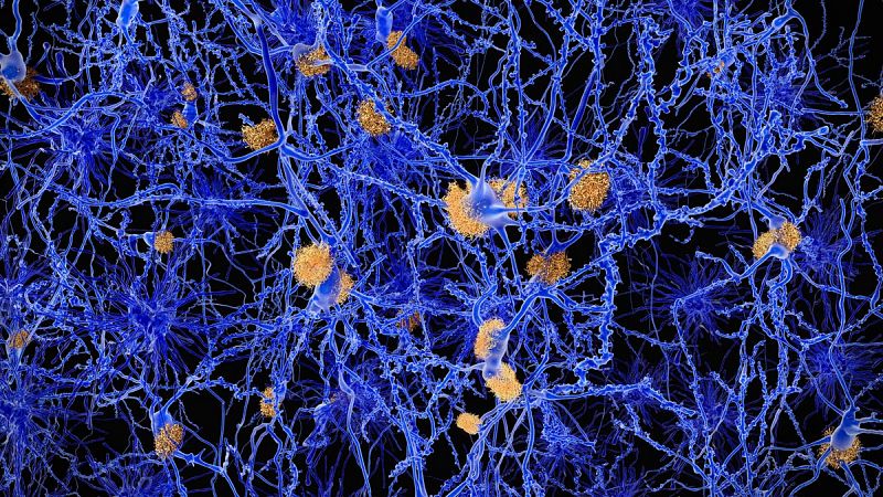 Los enfermos de alzhéimer tienen más riesgo de tumores cerebrales, pero menos de cáncer de pulmón