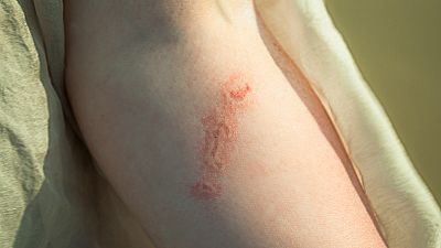 Farmacia Abierta - Picaduras de medusas - 17/07/17 - Escuchar ahora