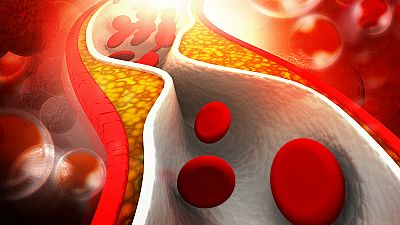 A su salud - Arteriosclerosis - 04/08/17 - Escuchar ahora