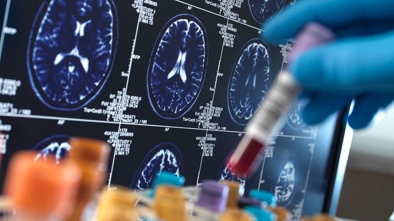 Detectan por primera vez cinco casos de alzhéimer por transmisión accidental entre humanos