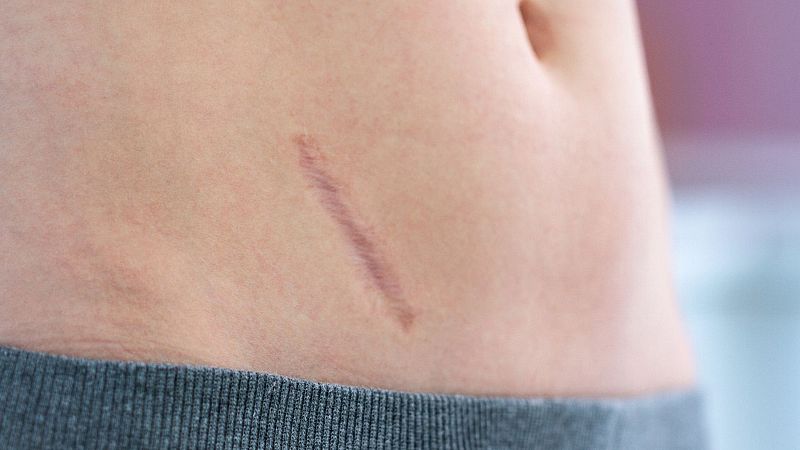 ¿Cómo es el proceso de cicatrización de una herida?