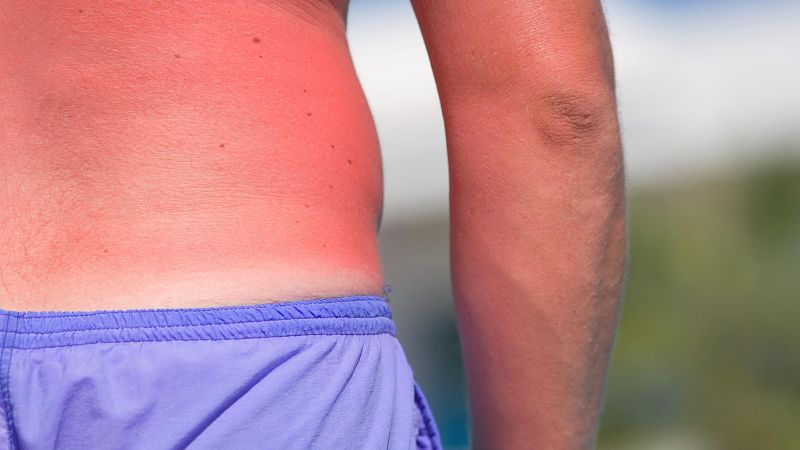 'Callo solar': el bulo que anima a tomar el sol sin protecci�n y que puede ocasionar da�os en la piel