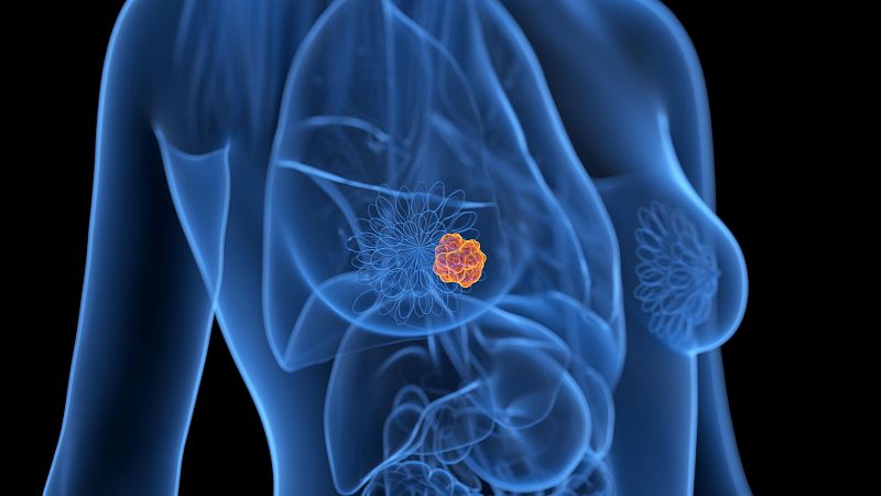 Una nueva combinaci�n de f�rmacos, libre de quimioterapia, reduce un 48% la progresi�n del c�ncer de mama avanzado