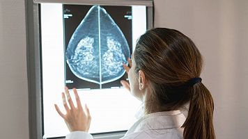El cncer de mama s el tumor ms freqent en dones a nivell mundial