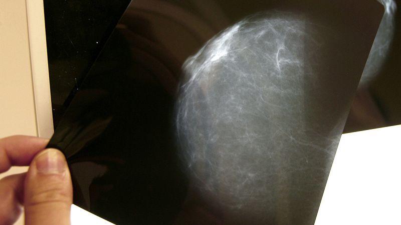 Una nueva tecnología hace mamografías con menos dolor, radiación y estrés