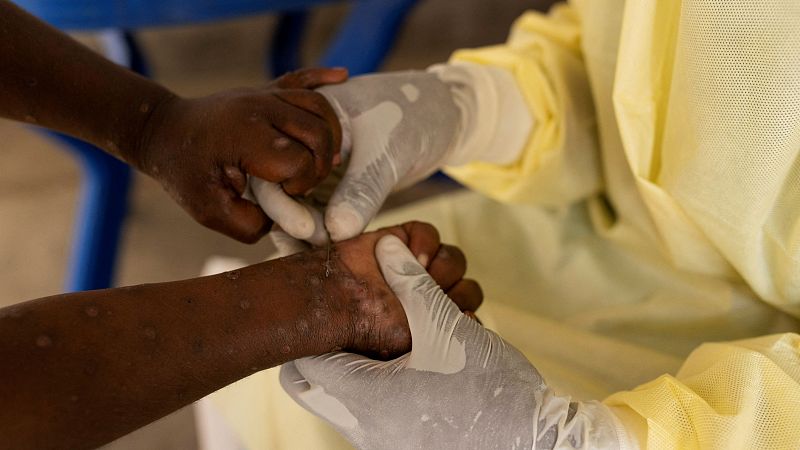 África declara la emergencia de salud pública ante la creciente epidemia de viruela del mono (mpox)