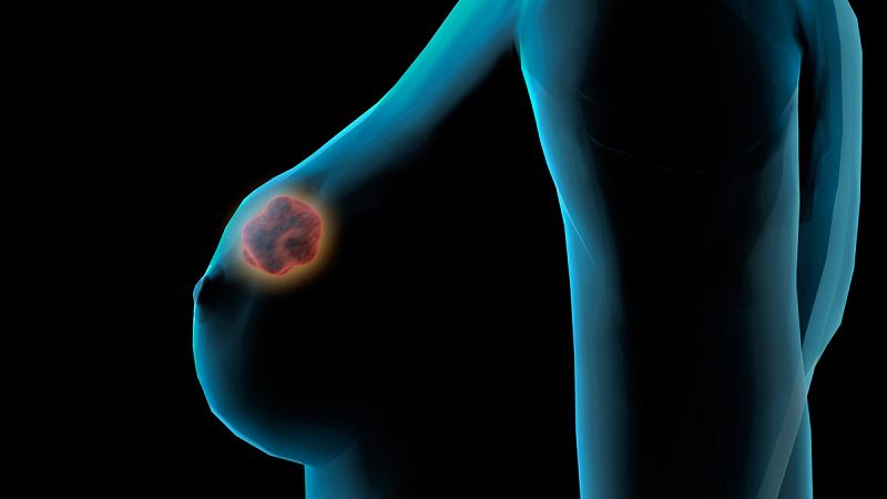 Descubren 72 variantes genéticas que elevan el riesgo de cáncer de mama