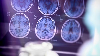 Alzheimer, los tratamientos pueden ralentizar su progresin