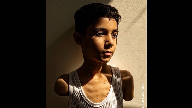 Un niño mutilado por un ataque israelí en Gaza, foto del año en el World Press Photo 2025