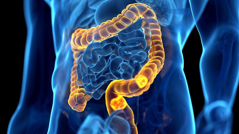 Un estudio relaciona el aumento del cncer colorrectal en jvenes con una infeccin en la infancia