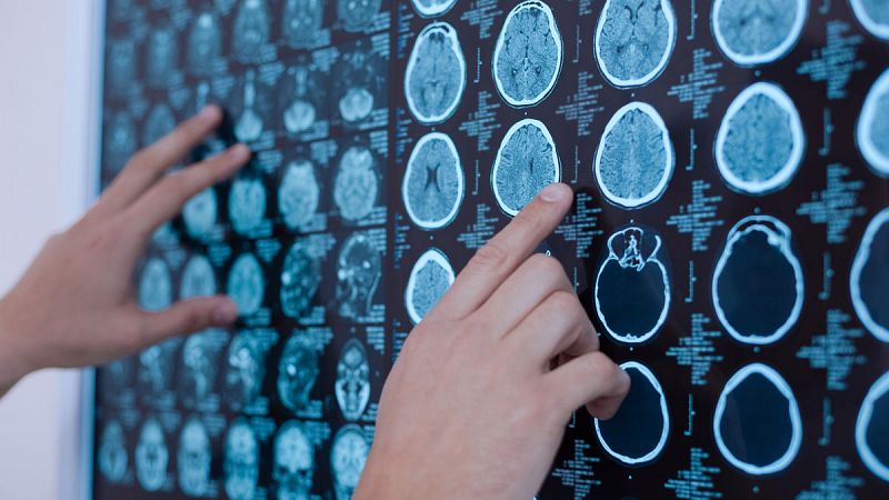 El hospital de La Fe acogerá un banco de cerebros para estudiar las dolencias neurológicas