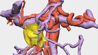 Las mañanas de RNE con Josep Cuní - Nueva técnica para extirpar cánceres de páncreas inoperables - Escuchar ahora