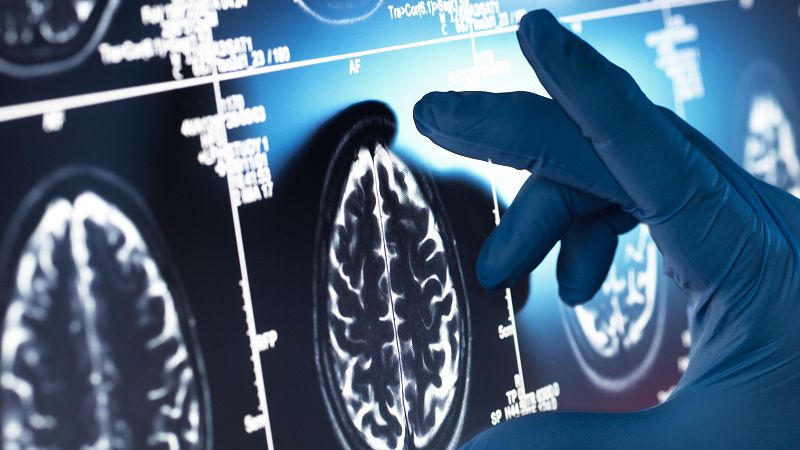 Investigadores de la Universidad de Castilla-La Mancha consiguen revertir dficits de memoria al principio del Alzheimer