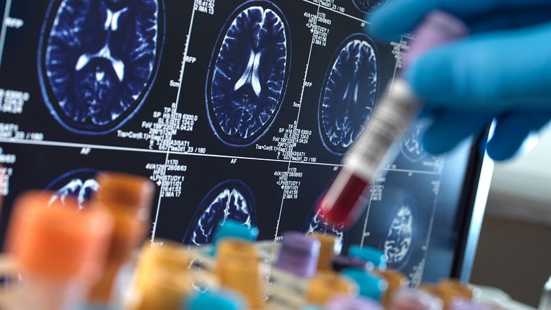 Cientficos espaoles descubren una alteracin en la captacin del colesterol en los pacientes con alzhimer