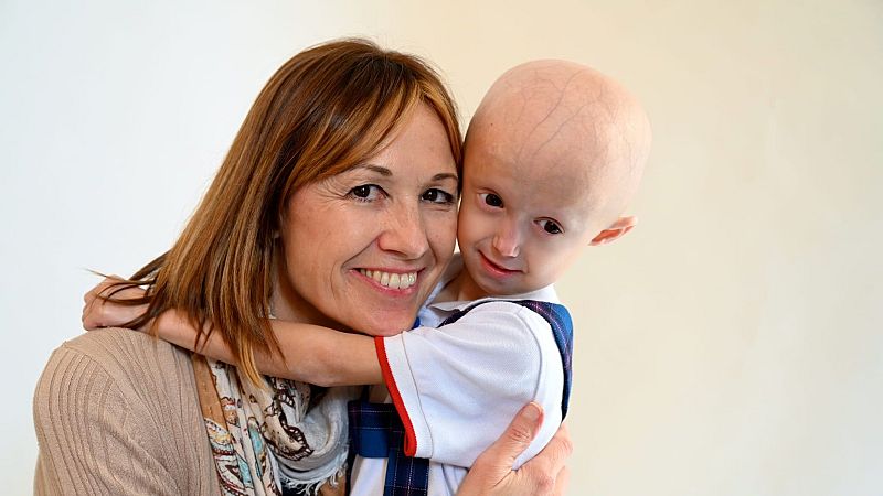 Progeria: envejecimiento prematuro de los niños