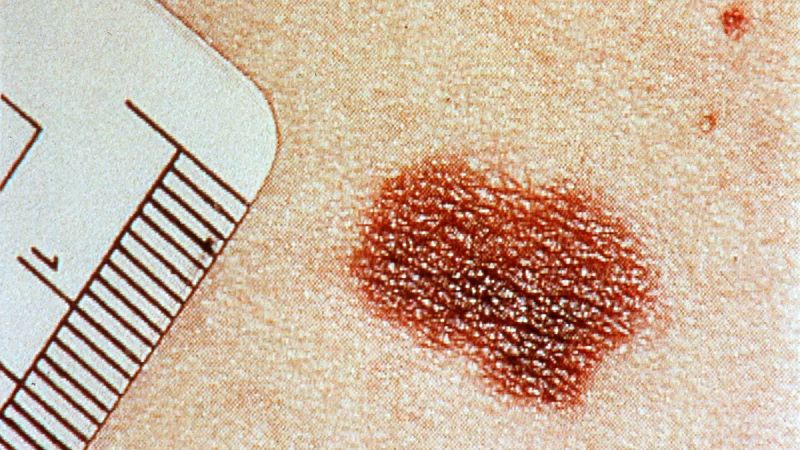 Presentan un test online instantáneo que predice el riesgo de melanoma con "gran precisión"