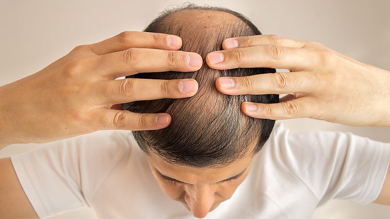 La clonación capilar será una realidad en diez años, según expertos en alopecia