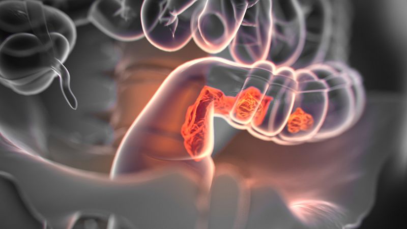 El cáncer de colon es el más frecuente en España, pero también el que más se cura
