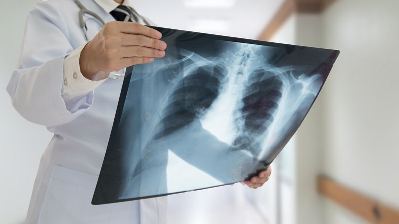Un nuevo tratamiento contra el cáncer de pulmón reduce el riesgo de muerte un 51%