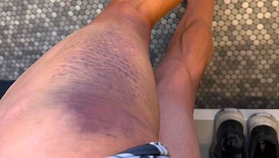 Primoz Roglic anuncia que fue golpeado por un coche y su participaci�n en La Vuelta a Espa�a queda en duda