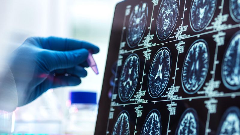 Científicos españoles descubren una vía para combatir la metástasis cerebral antes de que aparezcan los síntomas