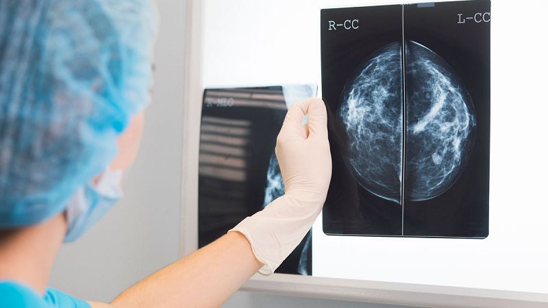 La inmunoterapia consigue por primera vez eliminar un cáncer de mama