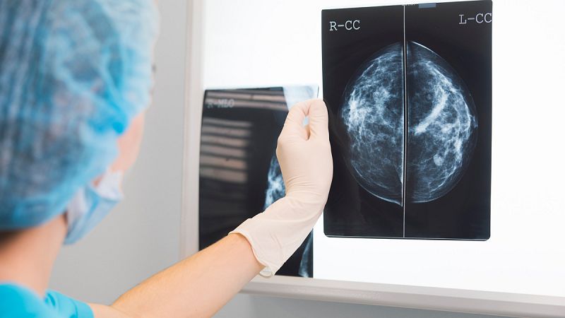 Estudian utilizar la inmunoterapia para tratar el cáncer de mama más agresivo