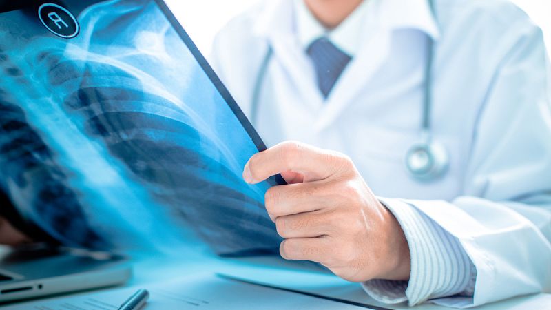 Descubren el motivo por el que la inmunoterapia es eficaz en determinados tipos de cáncer de pulmón