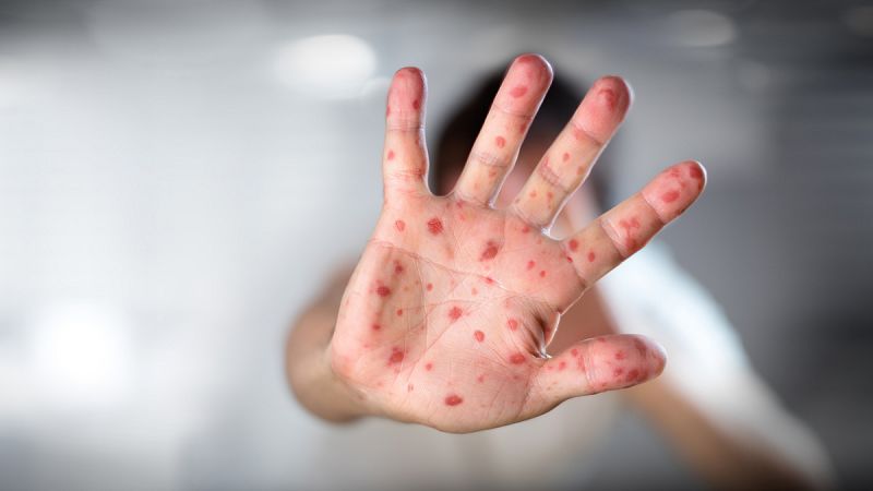 La OMS considera a España libre del contagio endémico del sarampión