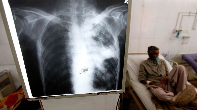 La OMS pide a los Gobiernos medidas decididas para acabar con la tuberculosis