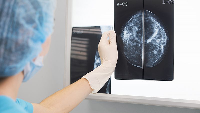 El cáncer de mama en cifras: una mujer diagnosticada cada 20 minutos en España