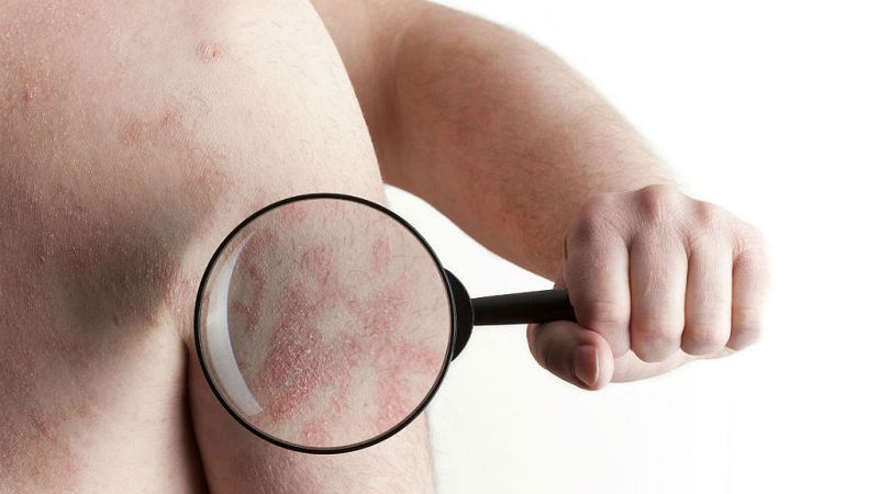 Psoriasis, una enfermedad sin cura y con un fuerte estigma social que afecta a un millón de personas en España