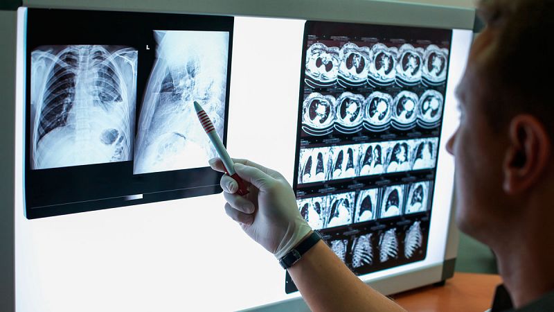 Un nuevo sistema permite el diagnóstico precoz del cáncer de pulmón