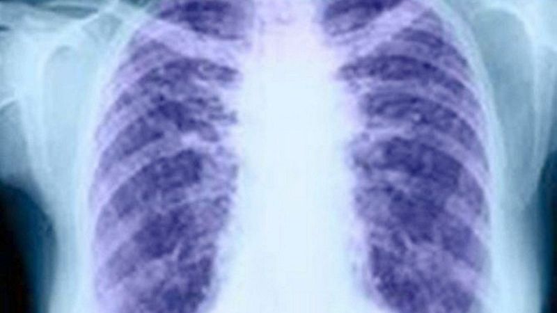 El cáncer de pulmón en cifras