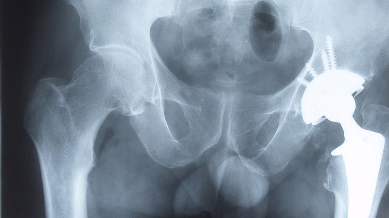 Los médicos creen que las prótesis en España son seguras pero admiten problemas de control