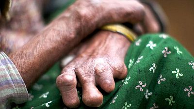 Memoria de delfín - Lepra: del aislamiento al diagnóstico precoz - 26/01/19 - escuchar ahora