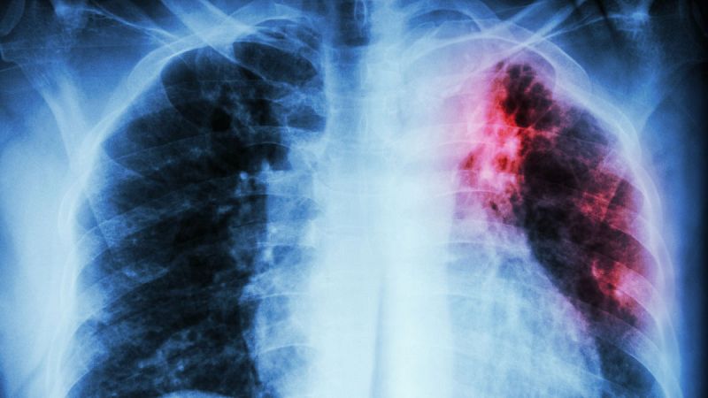 Piden cuadruplicar la inversión mundial en investigación para reducir un 90% las muertes por tuberculosis