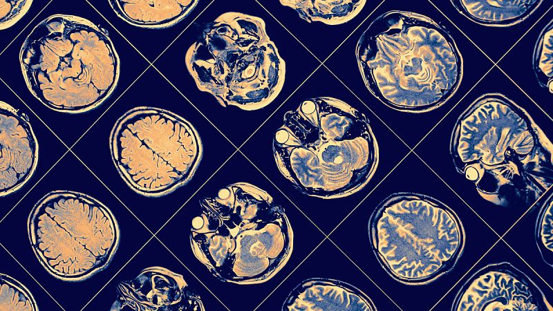 Descubren el umbral más bajo de la proteína cerebral asociada al alzhéimer