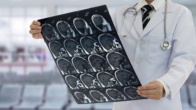 Una de cada seis personas sufrirá un ictus, y el 90% de ellos se pueden evitar