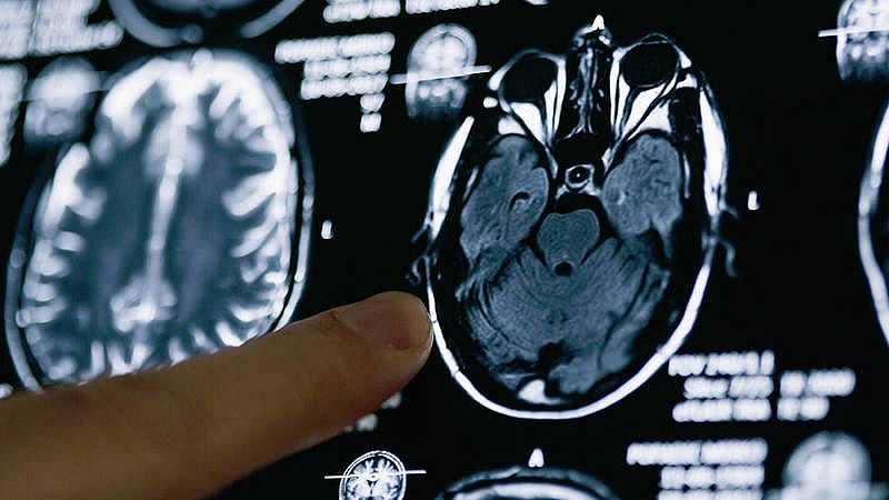 Investigadores españoles comprueban que un anticoagulante oral es capaz de retrasar la aparición del alzhéimer