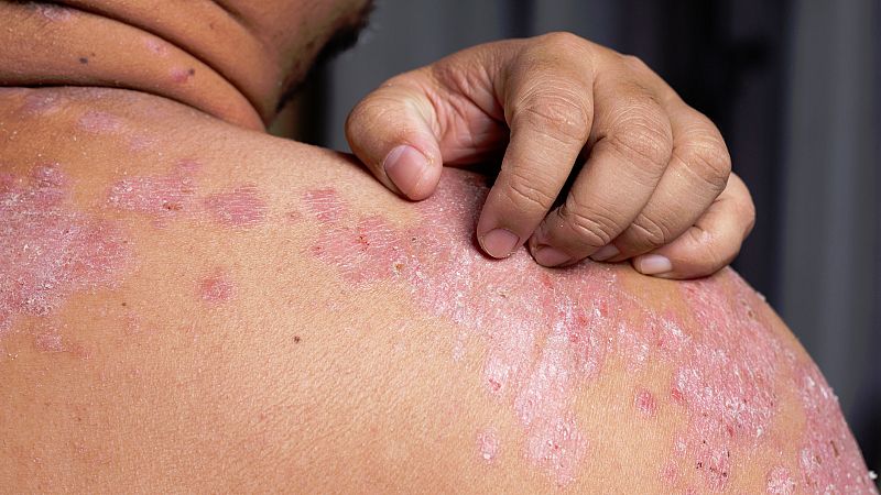 La psoriasis, una enfermedad que va más allá de una placa en la piel