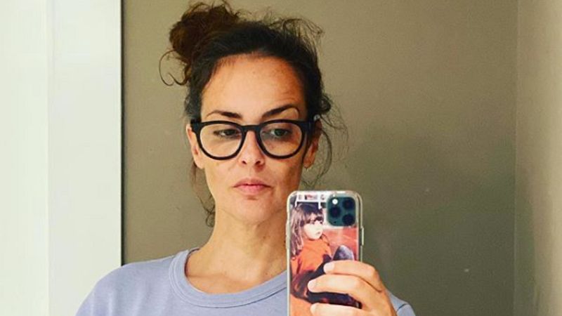 Vega sufre alopecia y confiesa de una manera valiente que no teme verse sin pelo