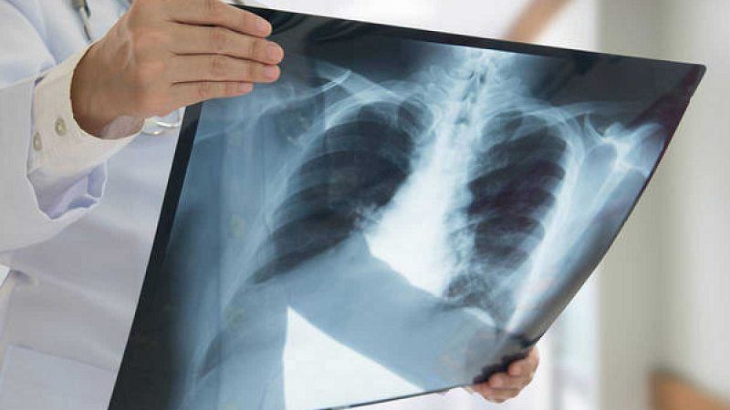 La inmunoradioterapia aumenta la supervivencia en pacientes con cáncer de pulmón metastásico