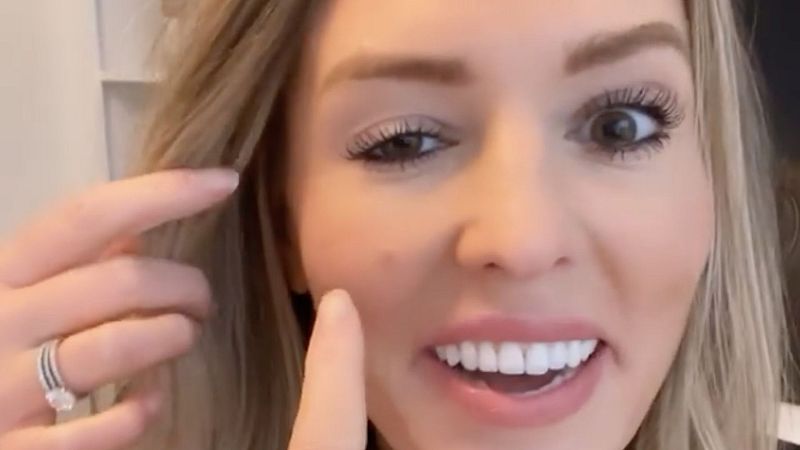 Una influencer muestra los destrozos que el bótox ha dejado en su cara